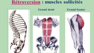 Antéversion bassin : causes et correction - Coach Parangon