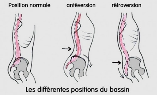 anteversion retroversion bassin schema