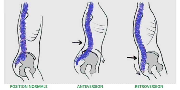 Schéma anatomique montrant la position neutre du bassin, l’antéversion et la rétroversion, utilisé en coaching sportif prévention blessures